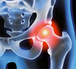geriatricarea osteoporosis Medicina Interna
