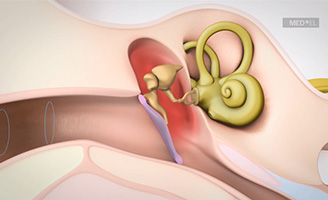 geriatricarea pérdida auditiva