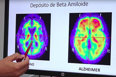 geriatricarea Alzheimer quironsalud