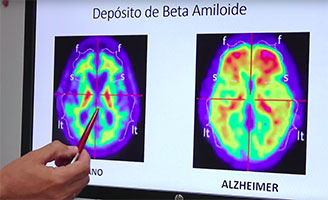 geriatricarea quironsalud Alzheimer