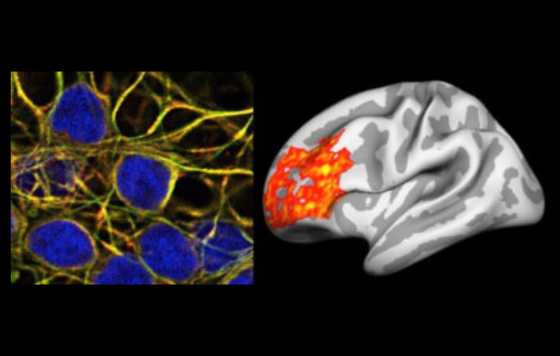 Geriatricarea- infección del virus herpes simple 1 se asocia con un incremento de la patología cerebral de la enfermedad de Alzheimer